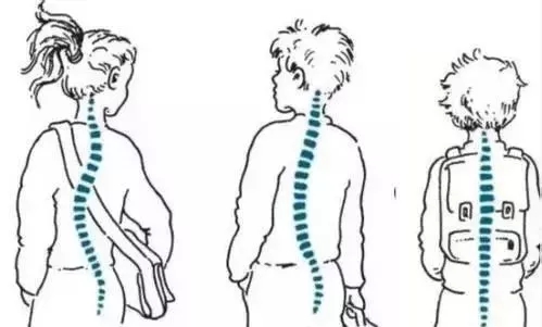 间充质病变并发脊柱侧弯症状有什么?